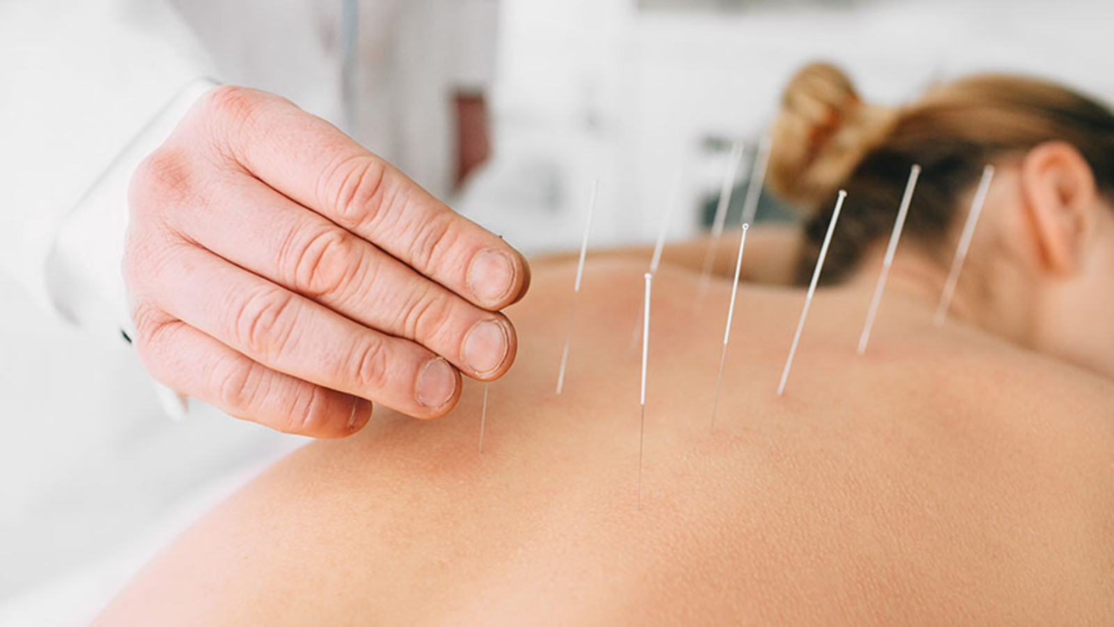 acupuntura